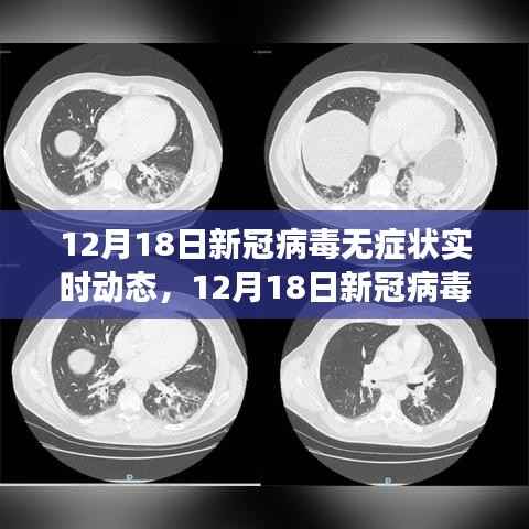 新冠病毒无症状实时动态全面解析,最新进展与关键信息速递(12月18日)